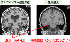 海馬・海馬傍回