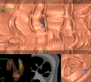 CTコロノグラフィー (大腸内視鏡モード)