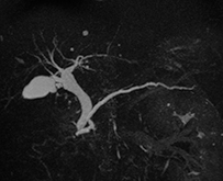 膵管胆管画像（MRCP）