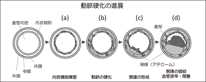 動脈硬化の進展