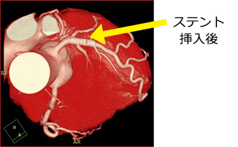 ステント挿入後