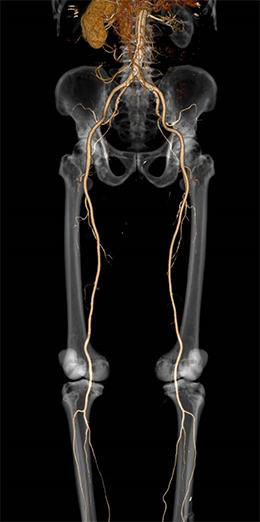 下肢動脈造影