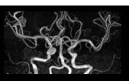 頭部MR血管像（MRA）