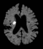 脳梗塞拡散強調画像