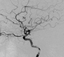 頭部血管DSA像